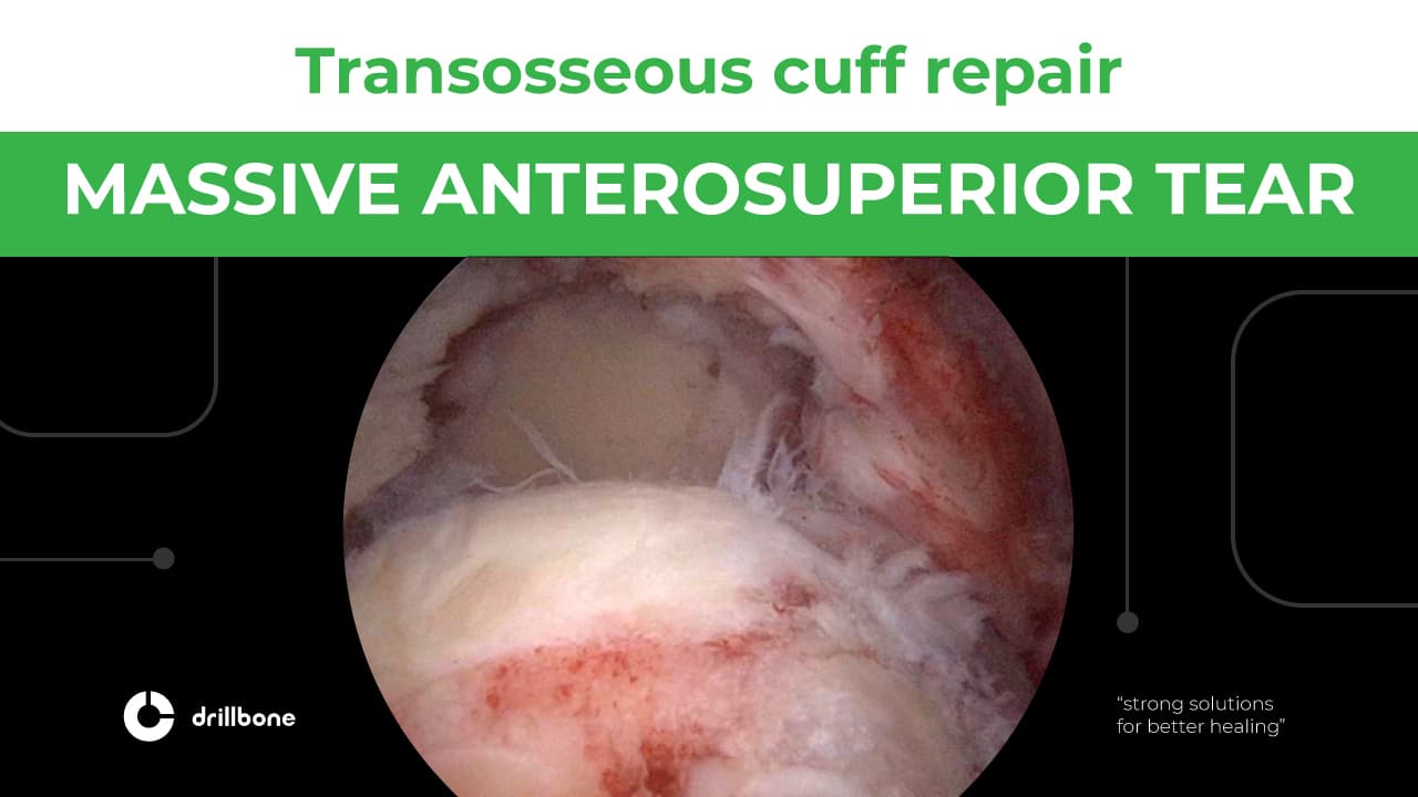 MASSIVE ANTROSUPERIOR TEAR