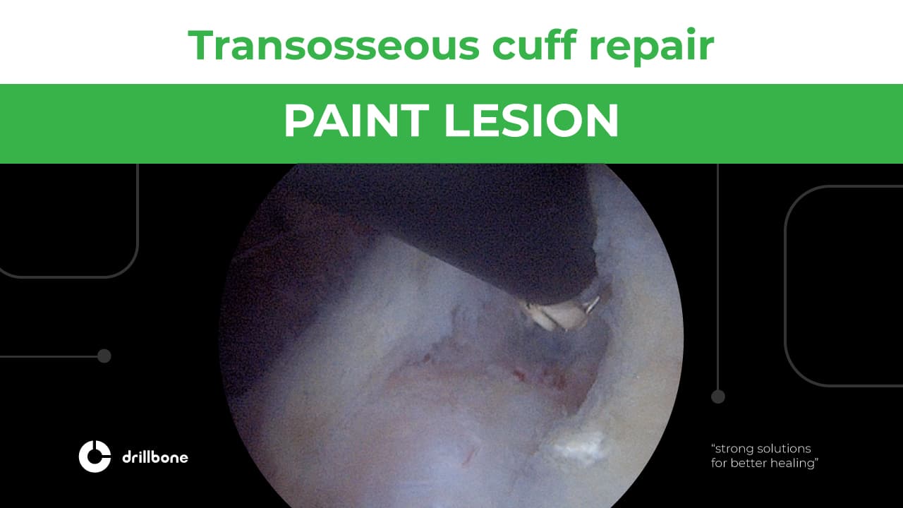 PAINT LESION