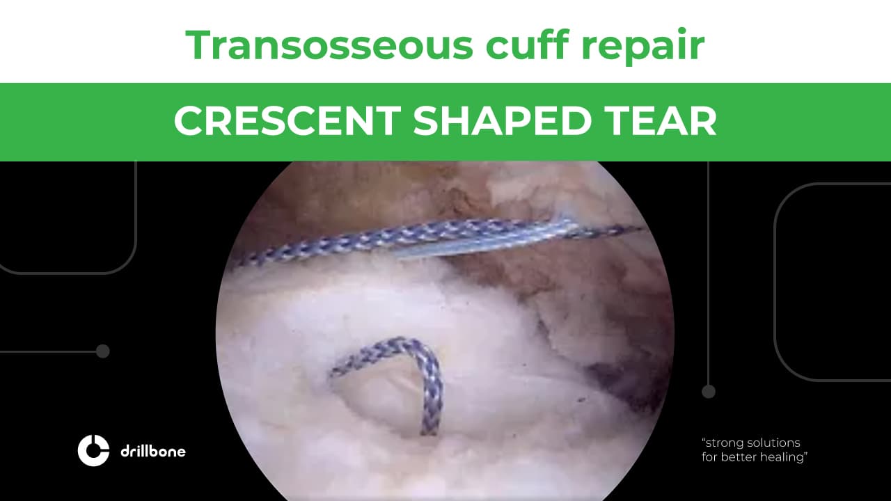 crescent shaped tear