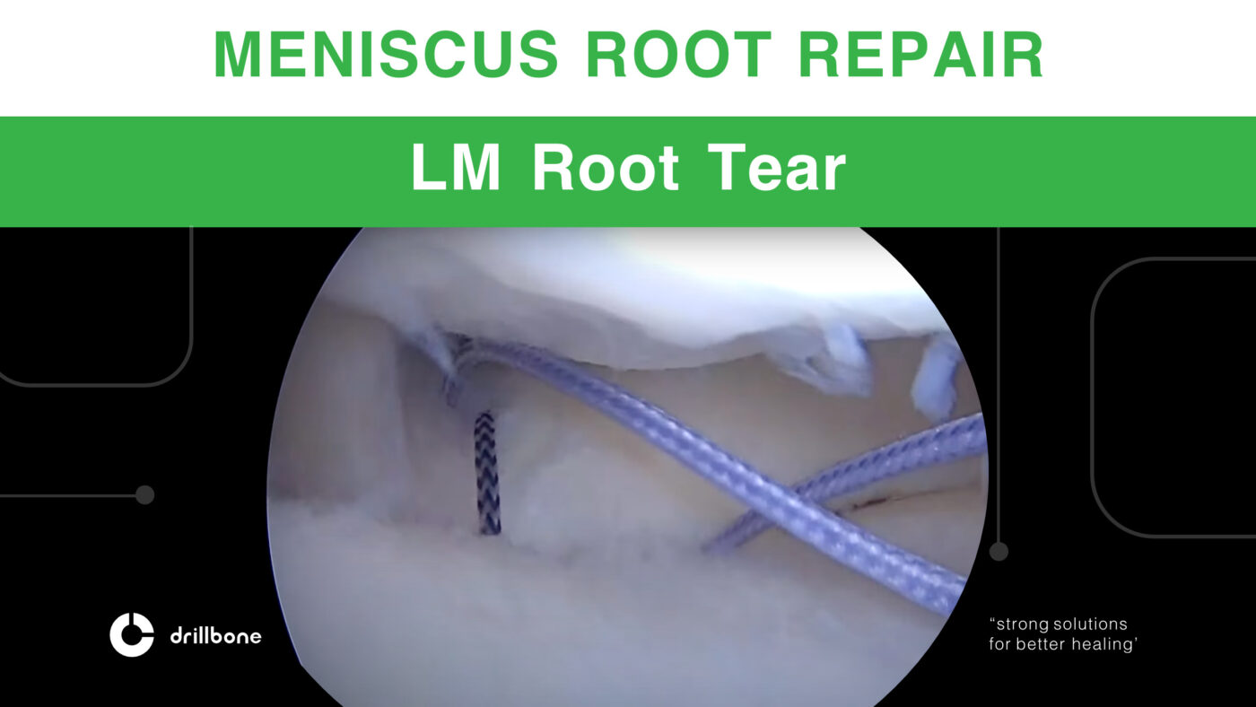 Lateral Meniscus Root Repair Two-tunnel Technique